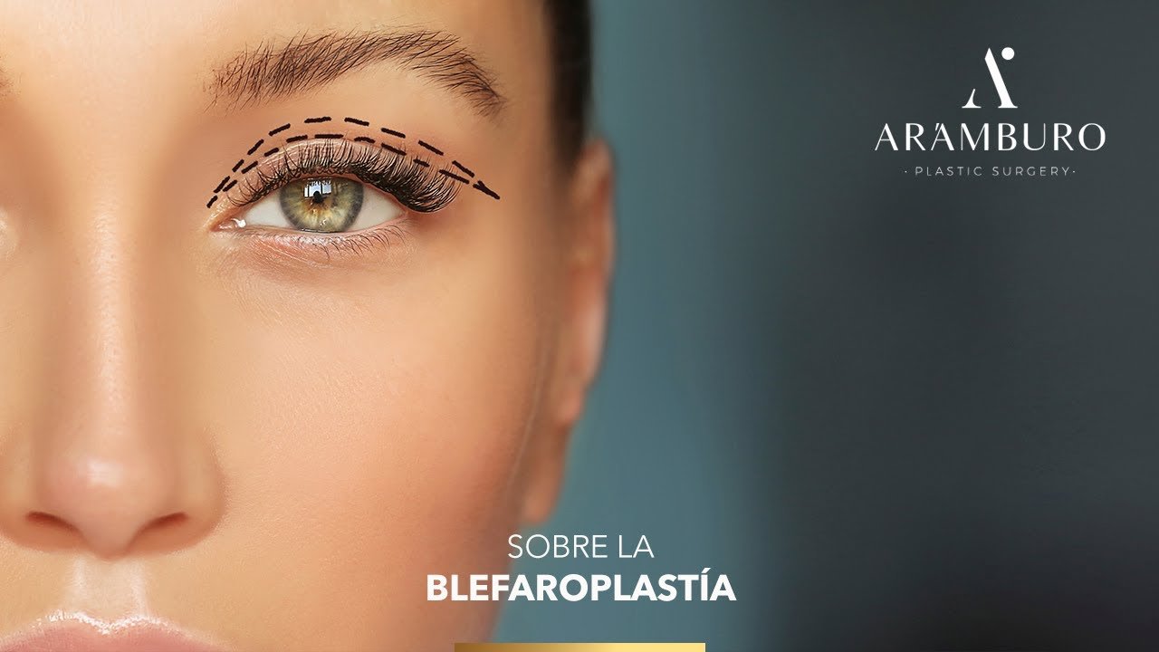 ¿Cómo es el proceso de una Blefaroplastia superior?